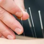 acupuntura castellar del valles