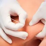 puncion seca castellar del valles